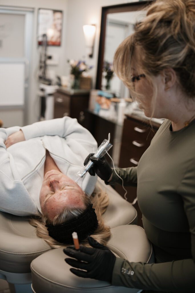 Microneedling with PRF